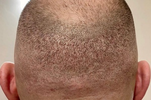 Лосьон Элоком для волос при алопеции – отзывы